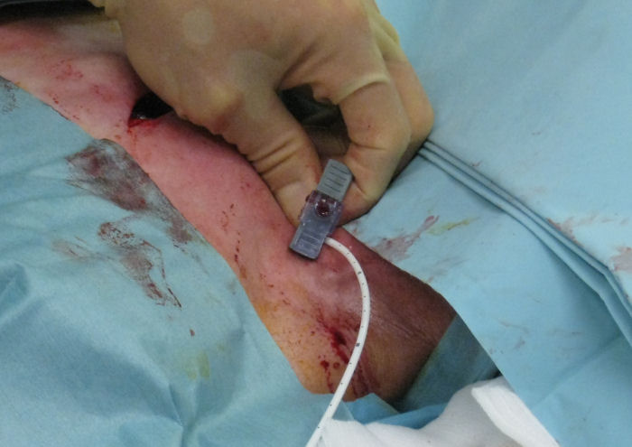 Pinching the sheath